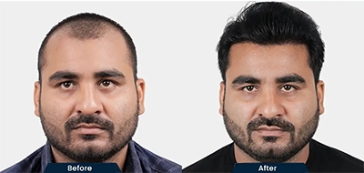 Before and After 1
